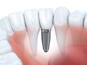 cosmetic dentist in Birmingham MI