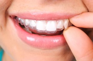 Your dentist in Bloomfield Hills straightens teeth without embarrassing metal. 